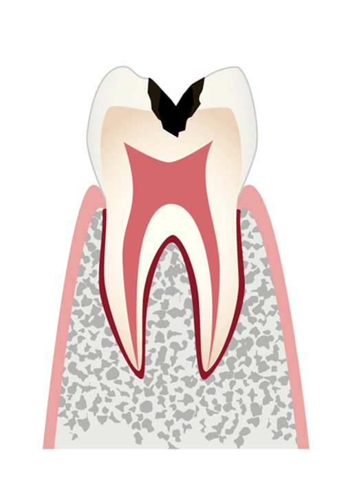 歯の中まで進んだ虫歯