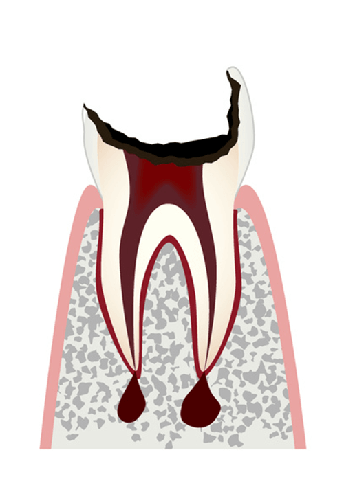 虫歯が歯の根まで進んだ歯