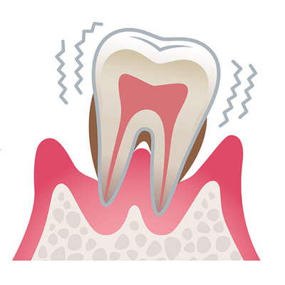 重症な歯周病